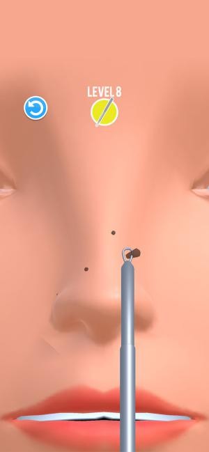 Lấy mụn đầu đen